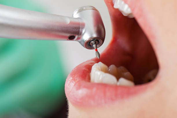Best Emergency Wisdom Teeth Removal in Mccordsville, IN